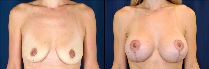 Lifting mammaire avant et après
