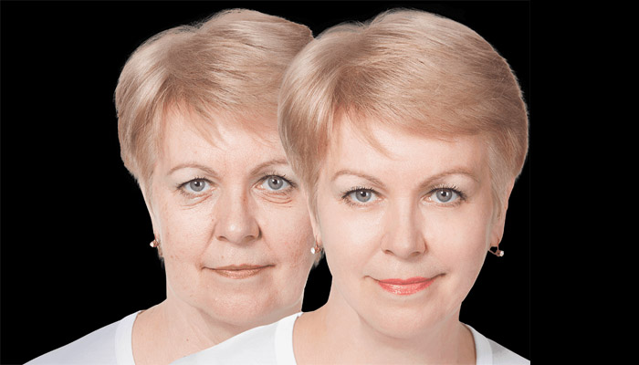Lifting du visage avant et après