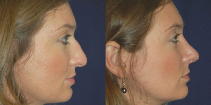 Chirurgie du nez avant et après