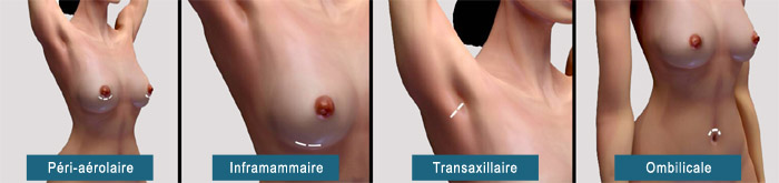 Incisions des seins pour mammoplastie