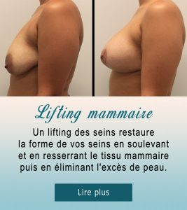 Lifting mammaire