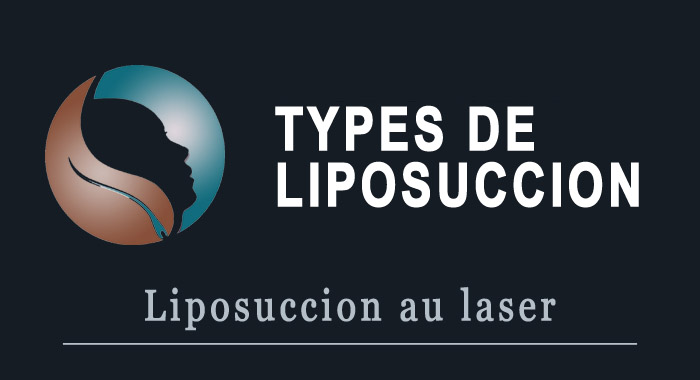 liposuccion-laser