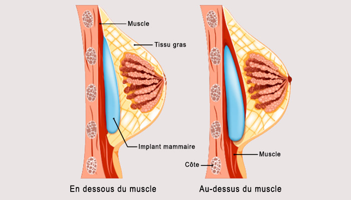 Position des implants mammaires