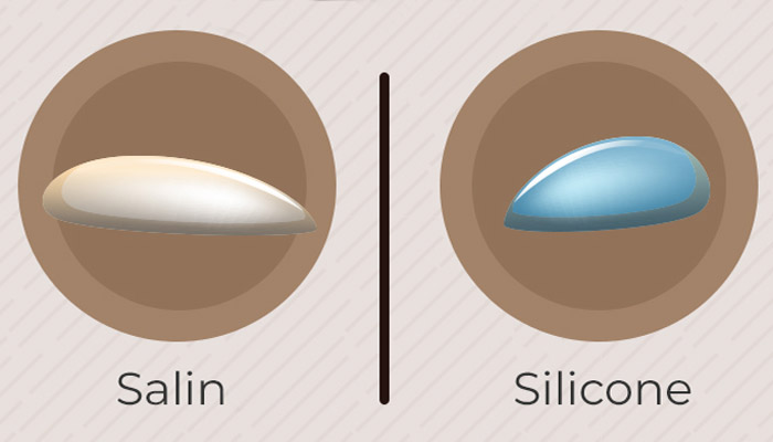 Types d'implants mammaires