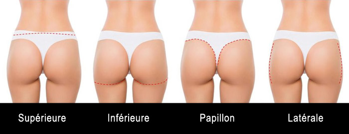 types-incisions-fesses
