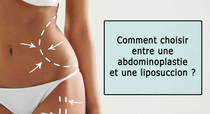 abdominoplastie-liposuction