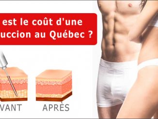 Quel est le coût d'une liposuccion au Québec