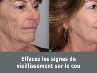 Vieillissement du cou