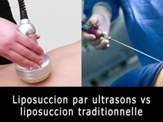 Liposuccion par ultrasons vs liposuccion traditionnelle