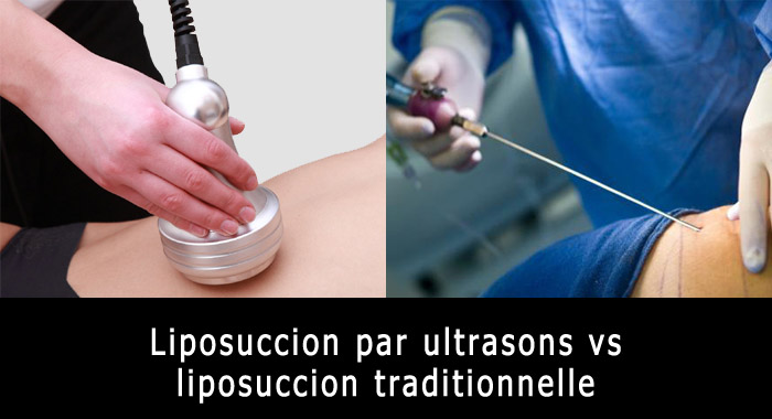 lipo-ultrason-traditionnelle