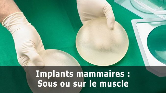 Implants mammaires : Sous ou sur le muscle