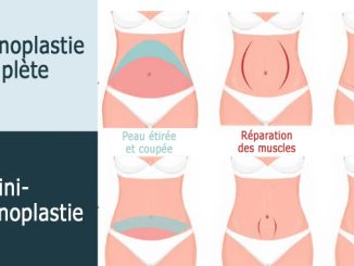 Mini-abdominoplastie ou abdominoplastie complète